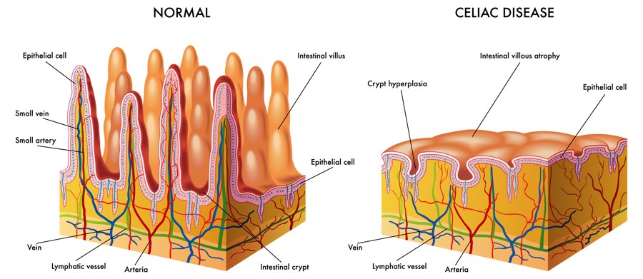 Cellular illustration of Celiac Disease depicting intestinal villous atrophy and crypt hyperplasia