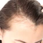 woman with hair loss and receding hairline